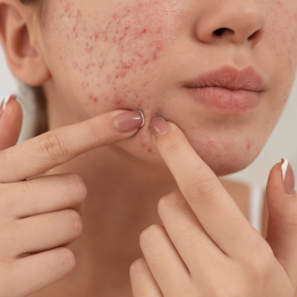 Was tun bei zu Akne neigender Haut?