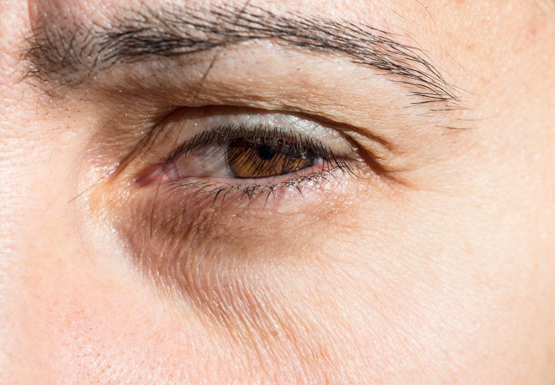 Trockene Haut unter den Augen